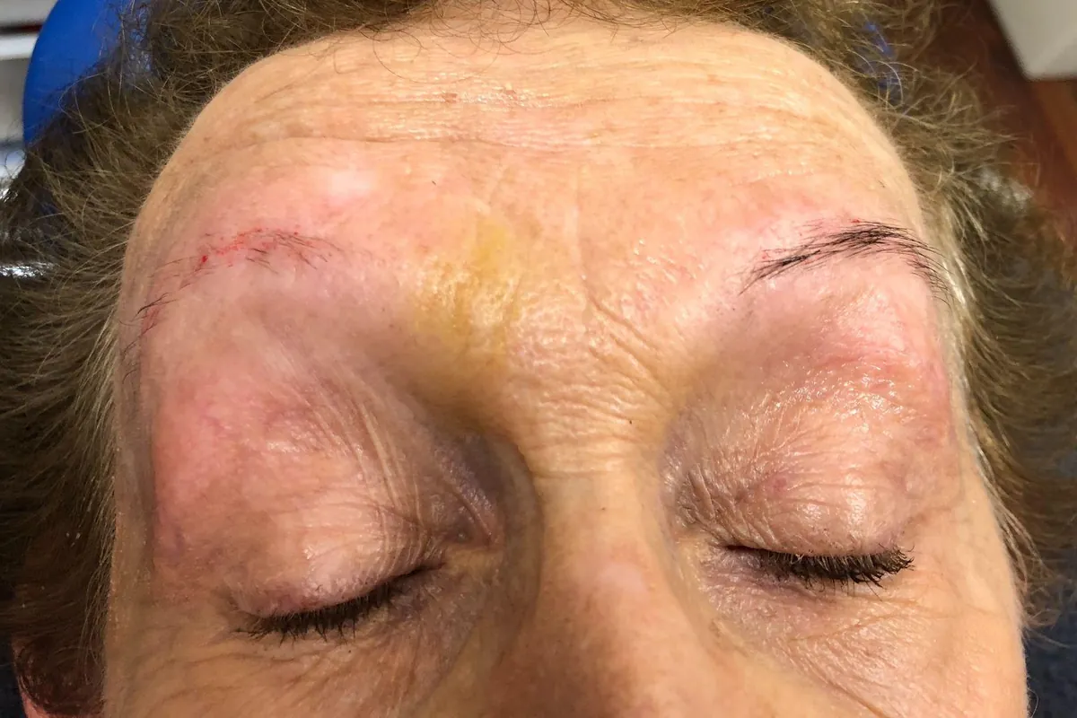 Before: a client with very sparse eyebrow hair, eyes closed