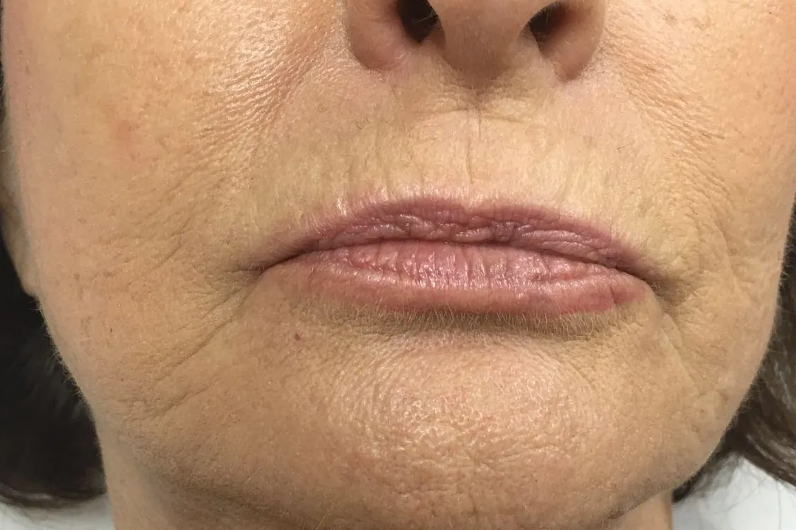 Before: a client's pale lips with little natural color or definition