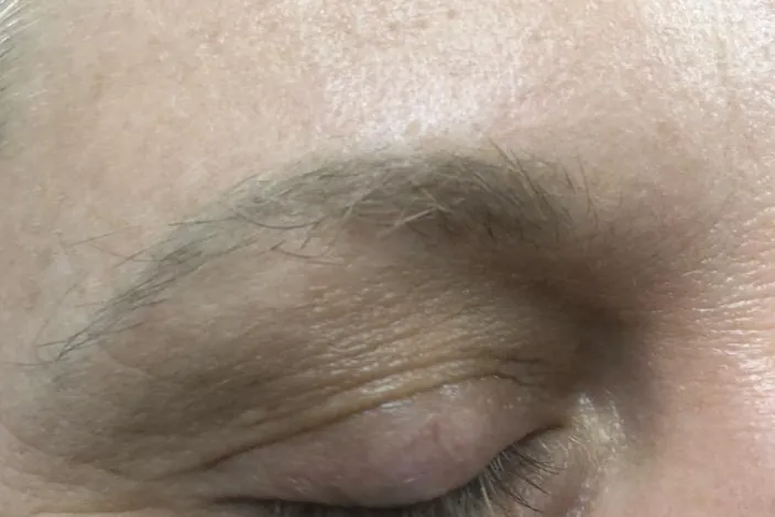 Before: closeup of an older brow tattoo faded to gray, with a blurred shape