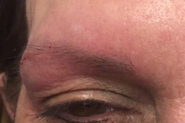 Before: closeup of a client's eye and brow, with only a few fine brow hairs left