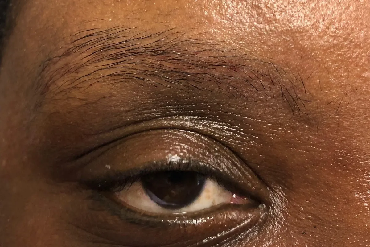 Before: closeup of a client's eye and brow, with sparse brow hairs